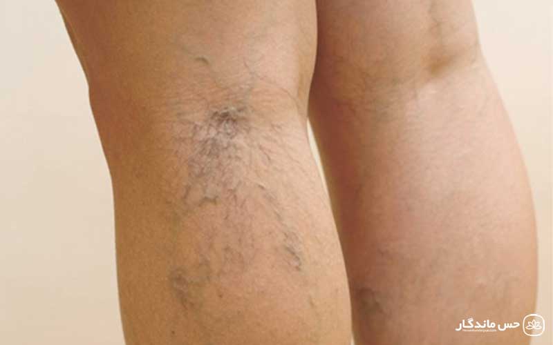 آیا ماساژ به بهبود واریس کمک میکند؟